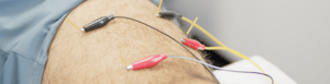 Dry Needling Pain Therapy