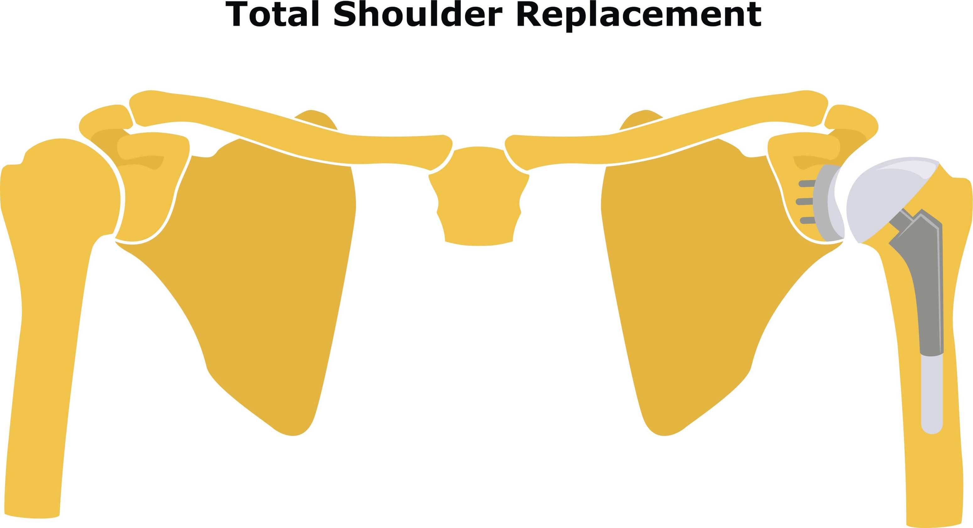 Anatomical Shoulder Replacement[47]