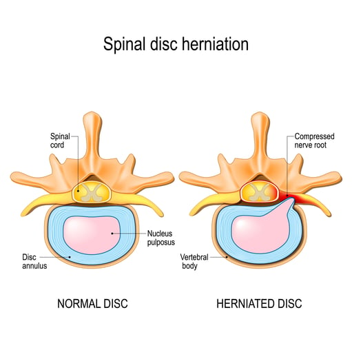 Disc Herniation FINAL-1