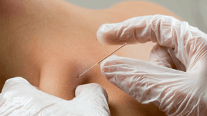 Close-up of a dry needling procedure.