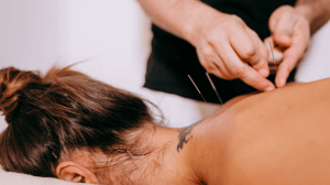 A woman lies on a table being dry needled in her back
