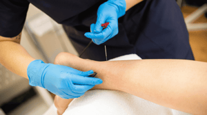 A practitioner does a dry needling treatment on a patient's calf.