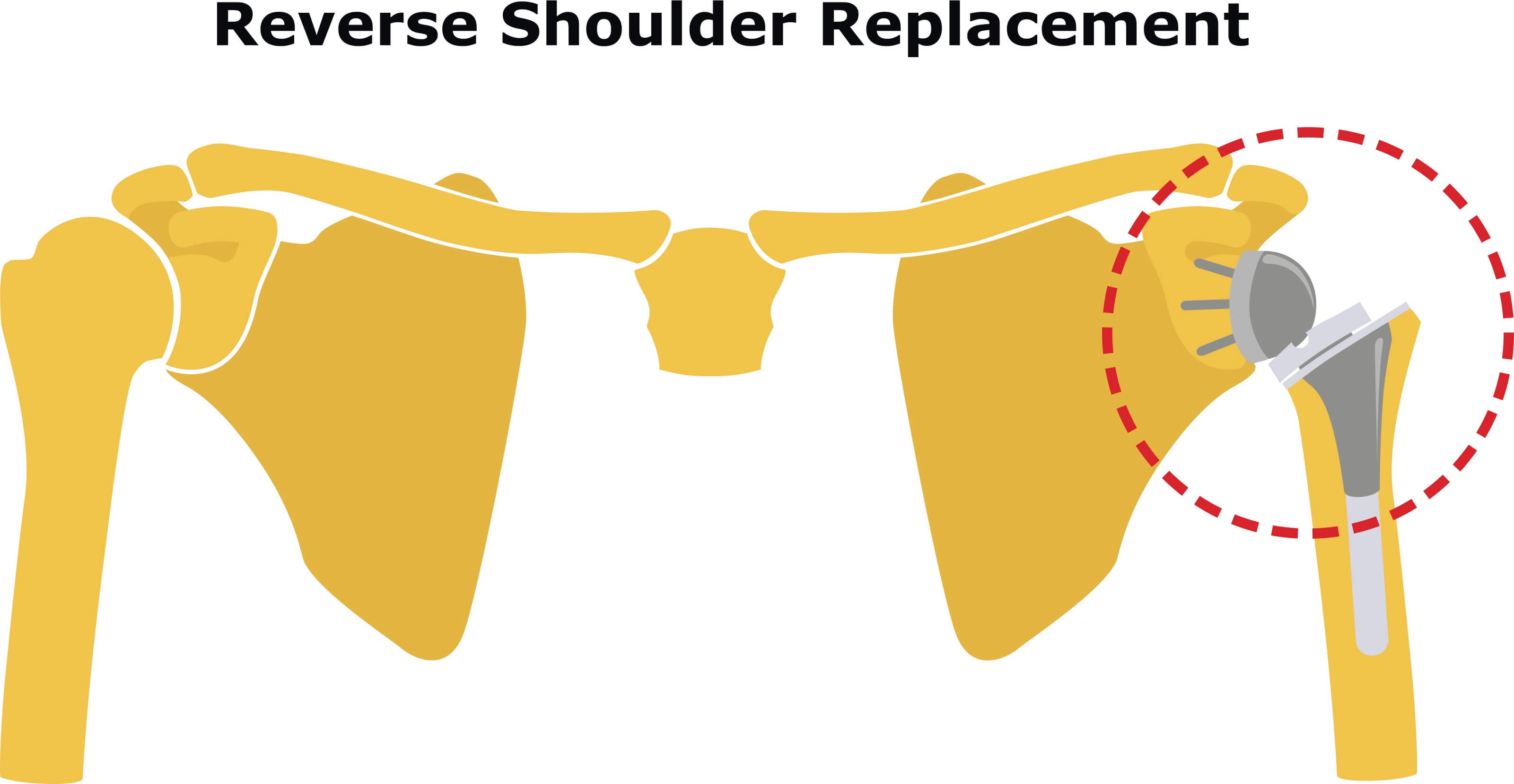 Reverse total shoulder[90]