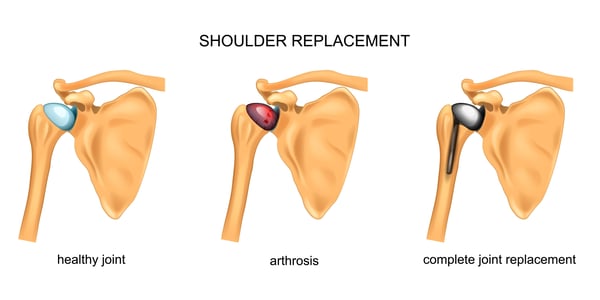 Shoulder replacement
