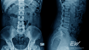 An X-ray of the lower back, from the front and side.