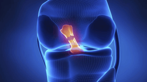 A medical diagram of a torn ACL.