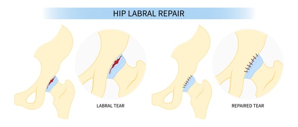 hip labrum repair