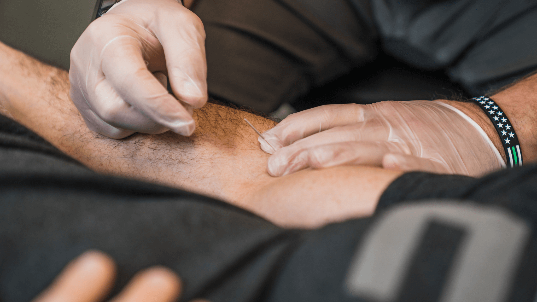 Dry Needling vs. Acupuncture: Which Treatment Is Right For You?